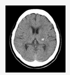 Brain CT
